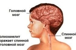 Места поражения полиомиелитом Места поражения полиомиелитом